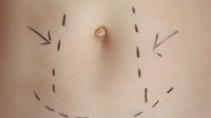 White Plains MD and Surrounding Areas a Growing Hub for Liposuction